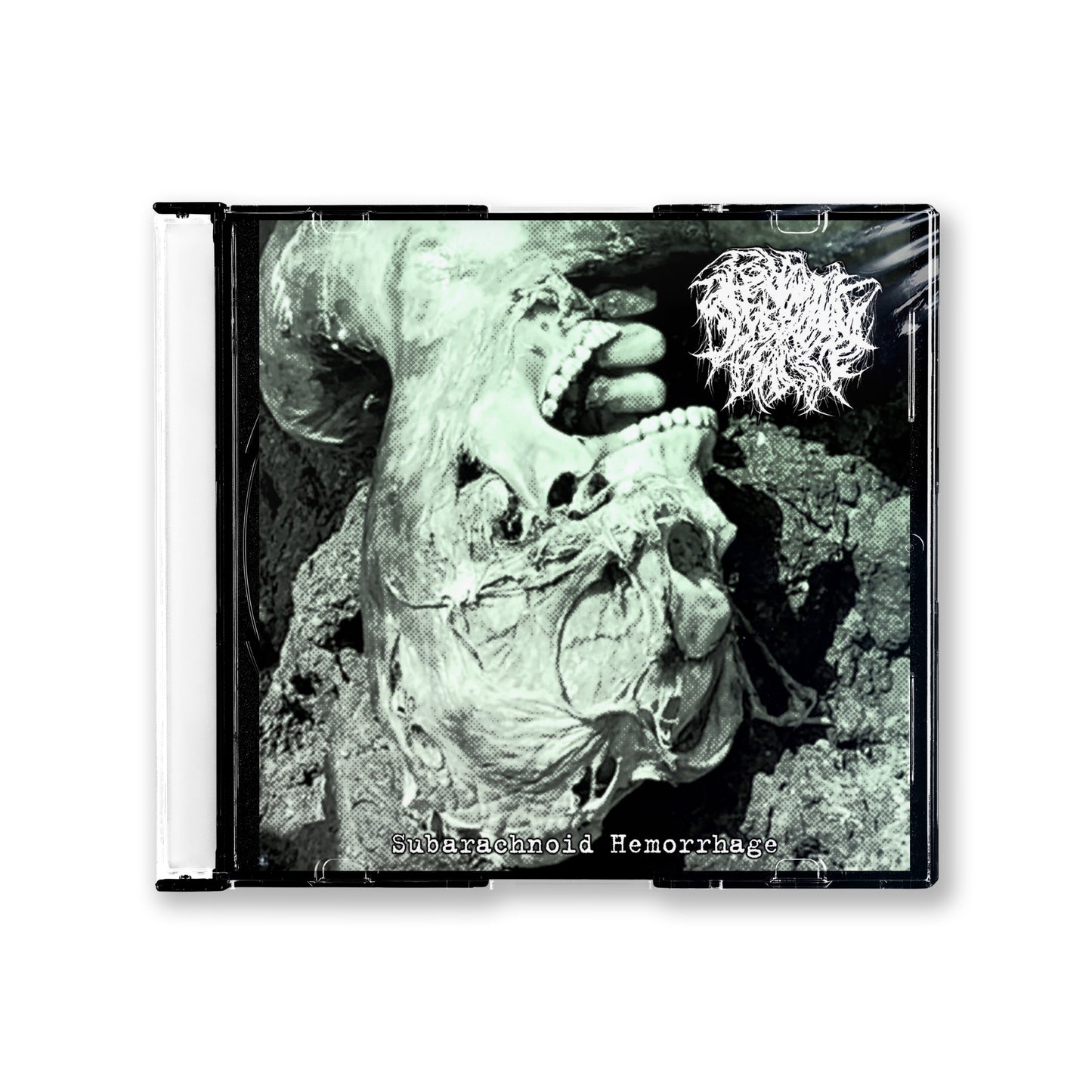 Alkaline Phosphatase "Subarachnoid Hemorrhage" CD